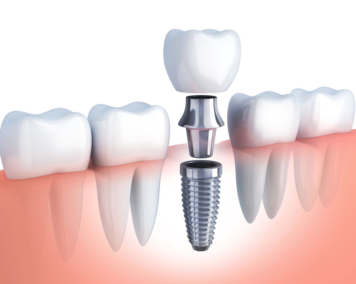 dental implants melbourne