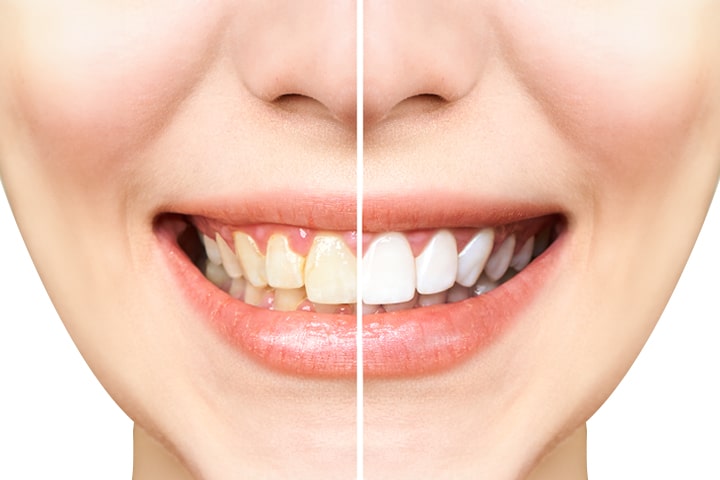 DOES DENTAL BONDING LOOK NATURAL min